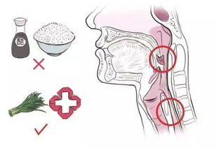 碎骨头鱼刺等安全知识