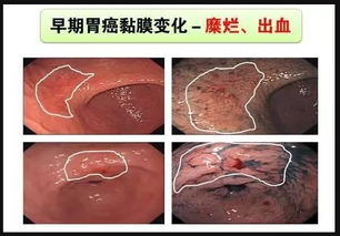 慢性萎缩性胃炎中医治疗方法有哪些