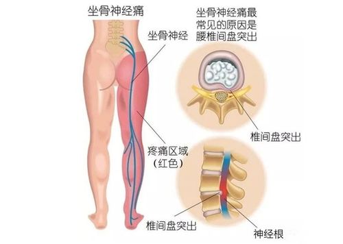 腰间盘突出做哪些锻炼方法