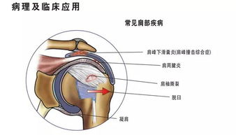 肩周炎的的治疗方法有哪些