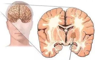 比较小的肿瘤不手术有哪些方法切除