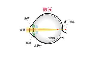 防止散光的方法有哪些