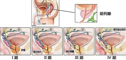 前列腺癌的检查方法有哪些呢