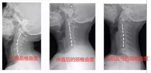 有哪些方法可以缓解背部疲劳