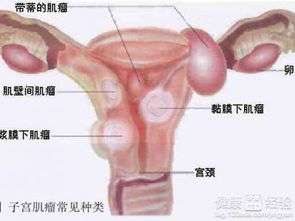 常见的治疗子宫肌瘤有哪些方法