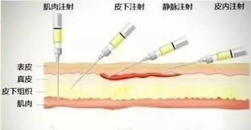 药物注射的方法有哪些