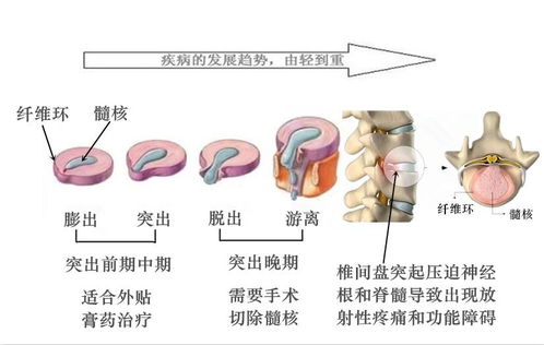 吊线风的治疗方法有哪些