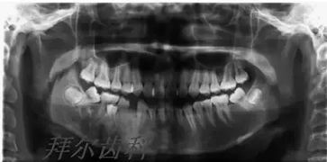 拔牙后不正确止血方法有哪些