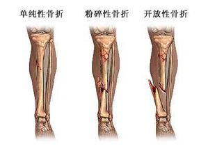 腿部骨折方法有哪些