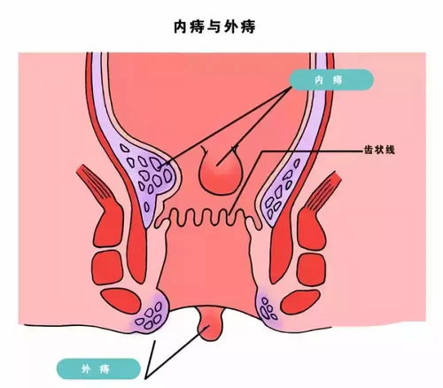 痔疮治愈的方法有哪些