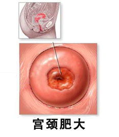 常见的治疗宫颈肥大方法有哪些