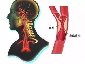 动脉硬化的治疗方法有哪些动脉硬化怎么办