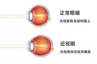 矫正近视的最常用方法有哪些方法