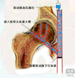 浙江省股骨头坏死的治疗方法中要有哪些