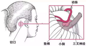 治疗神经的方法有哪些