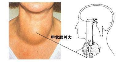 甲状腺肿大有效治疗方法有哪些