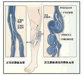 大腿静脉曲张的治疗方法有哪些