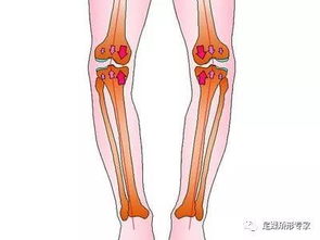 o型腿治疗方法有哪些