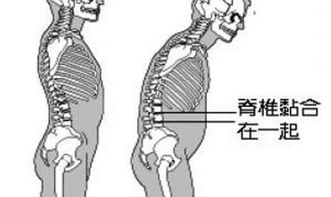 最新强直性脊柱炎治疗方法有哪些