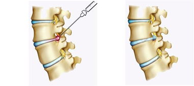 腰腿痛的手术治疗方法有哪些