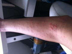 昆明治疗荨麻疹方法有哪些