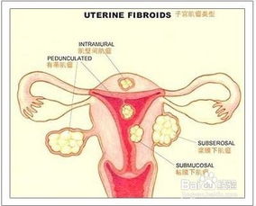 孕妇有子宫肌瘤饮食注意事项,子宫肌瘤和卵巢囊肿饮食注意事项,子宫肌瘤手术后饮食注意事项