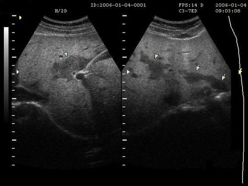 B超检查注意事项,肝脏B超检查注意事项,腹部B超检查注意事项