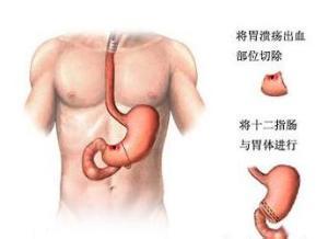 胃出血的饮食注意事项,胃出血出院后饮食注意事项,胃出血的注意事项和饮食