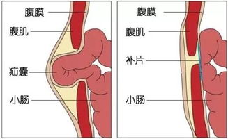 疝气修补术后注意事项