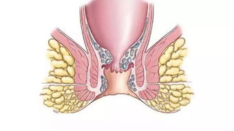 肛裂的注意事项,肛裂饮食注意事项,肛裂术后注意事项