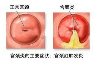 宫颈息肉要注意事项