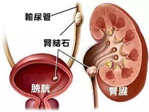 患有肾结石需注意事项