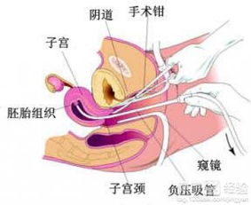 吃药打胎后需要注意什么,药流后有什么注意事项,药物打胎后注意事项有哪些