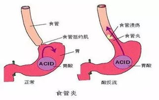 返流性食管炎注意事项