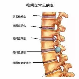 腰椎间盘小关节综合症注意事项