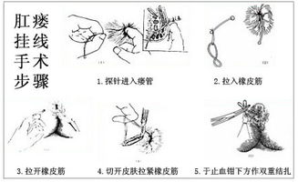 肛瘘,术前,注意事项