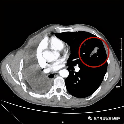 做完pet-ct之后注意事项