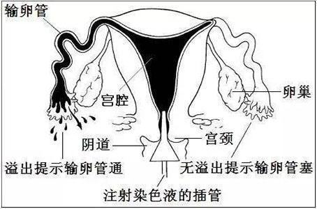 输卵管造影检查前注意事项