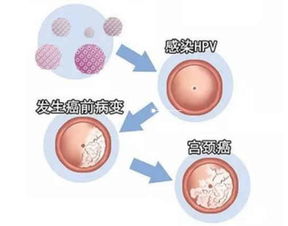 取宫颈hpv标本注意事项