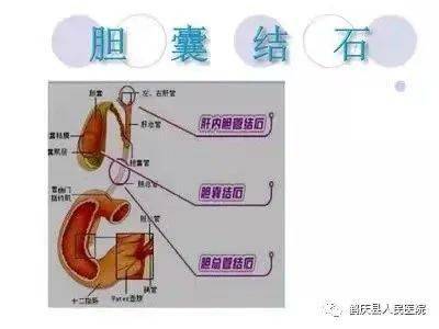 刚做完胆囊切除应注意事项