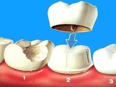 做牙冠后注意事项