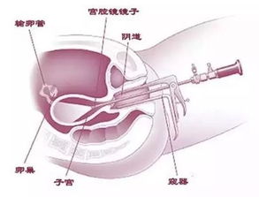 试管宫腔镜注意事项