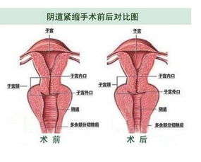 阴道紧缩术后注意事项