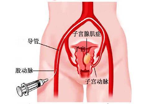 粘膜下子宫肌瘤宫腔镜手术后多久可以恢复,粘膜下子宫肌瘤宫腔镜手术后十天还有血,粘膜下子宫肌瘤宫腔镜手术后多久可以同房