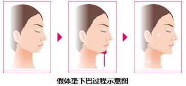 假体下巴做完后的注意事项,假体下巴术后注意事项,假体下巴饮食注意事项