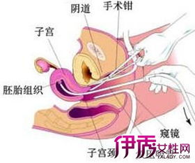 做完宫腔灌注注意事项,宫腔灌注注意事项,膀胱癌灌注后注意事项