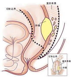 肛门乳头瘤手术后饮食注意事项