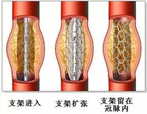 心脏血管狭窄注意事项