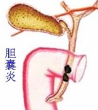 胆结石切胆后注意事项