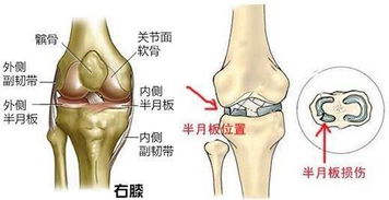 小孩膝盖半月板损伤注意事项